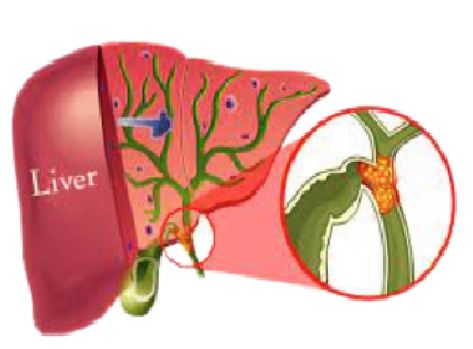 Cholangiocarcinoma is a cancer, also called bile duct cancer, that forms in the bile ducts