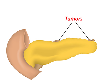 Pancreatic cancer, Pancreatic Tumor removal in Bangalore