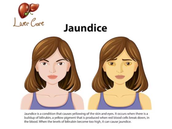 Jaundice treatment in Bangalore