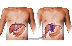 Deceased Donor Liver Transplantation in Bangalore