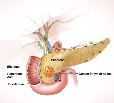 Neuroendocrine tumours of pancreas treatment in Bangalore